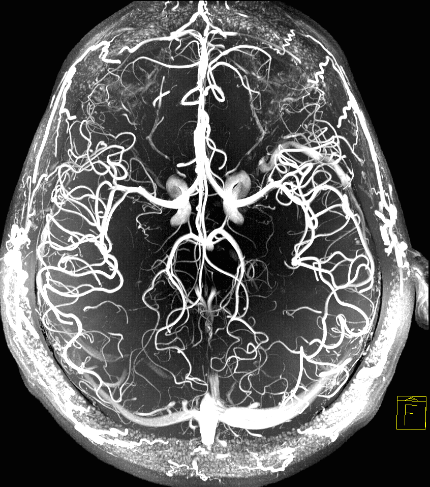 снимок МРТ сосудов головного мозга